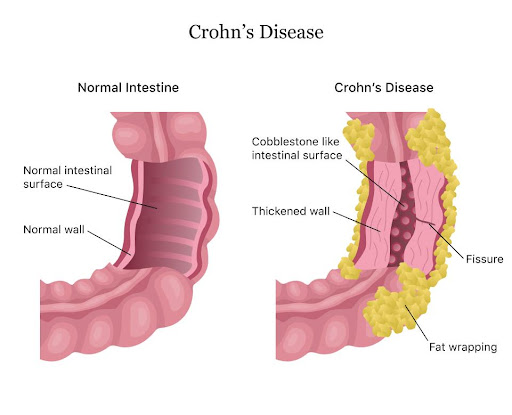 crohns diesease