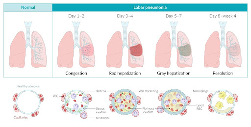 Lobar Pneumonia