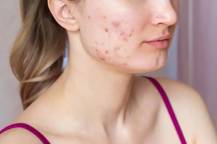 Tired of Acne-Prone Skin