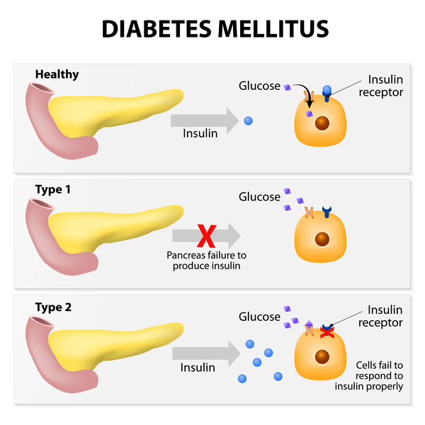 diabetes mellitus